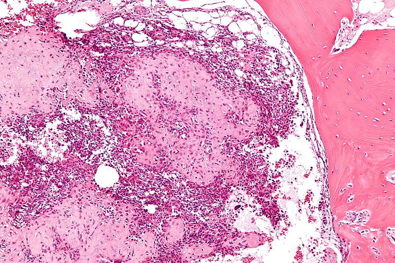 Chondroblastoma Histology